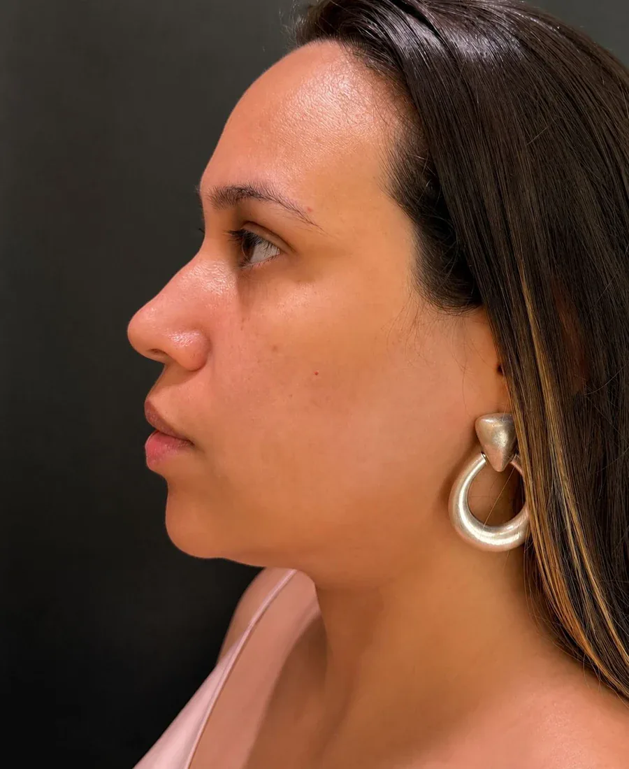 Perfil do rosto depois do planejamento full face